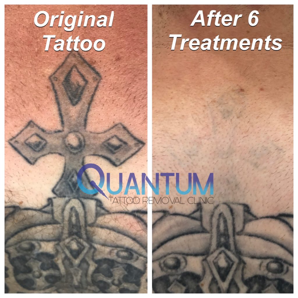 before and after black light ink tattoo