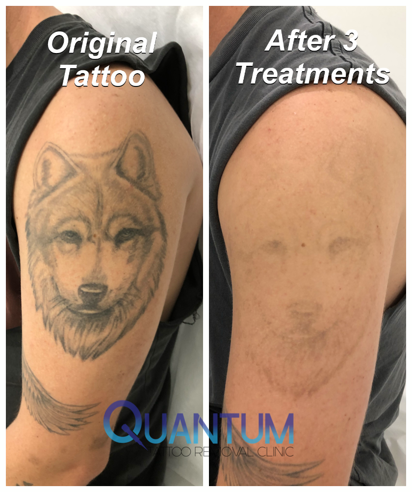 Professional Lightening Tattoo Removing in Brisbane, Australia - Tattoo Ink  Removal
